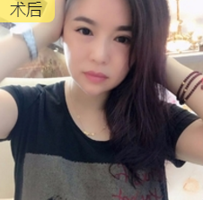 重庆超雅去眼袋手术,安全又省钱902 重庆超雅去眼袋手术,安全又省钱902