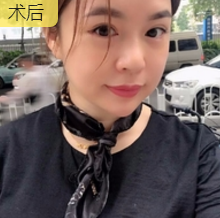 重庆超雅去眼袋手术,安全又省钱902 重庆超雅去眼袋手术,安全又省钱902