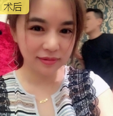 重庆超雅去眼袋手术,安全又省钱902 重庆超雅去眼袋手术,安全又省钱902