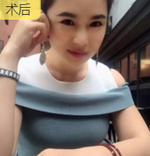 重庆超雅去眼袋手术,安全又省钱902 重庆超雅去眼袋手术,安全又省钱902