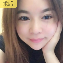 重庆超雅去眼袋手术,安全又省钱902 重庆超雅去眼袋手术,安全又省钱902