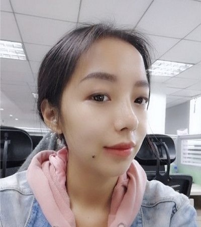 超 声 波去眼袋,你得眼袋就会被轻松得去除 超 声 波去眼袋,你得眼袋就会被轻松得去除