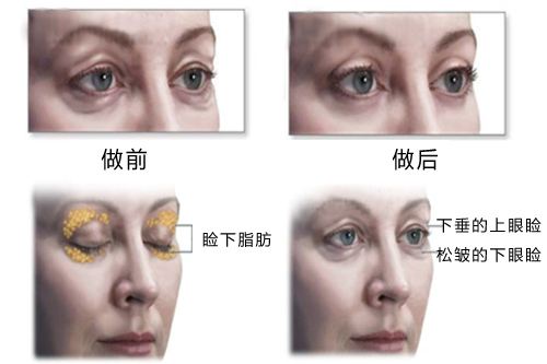 想做安全的去眼袋手术就用重庆超雅的技术376 想做安全的去眼袋手术就用重庆超雅的技术376