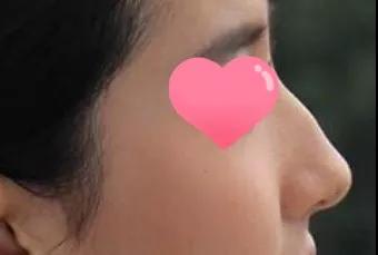重庆超雅隆鼻手术让你成为隆鼻范本005 重庆超雅隆鼻手术让你成为隆鼻范本005