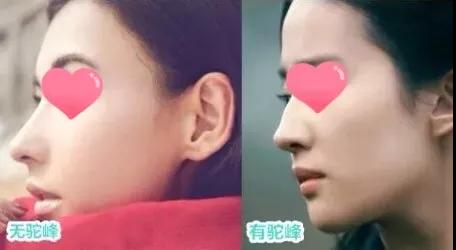 重庆超雅隆鼻手术让你成为隆鼻范本005 重庆超雅隆鼻手术让你成为隆鼻范本005