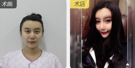 重庆超雅隆鼻手术让你成为隆鼻范本005 重庆超雅隆鼻手术让你成为隆鼻范本005