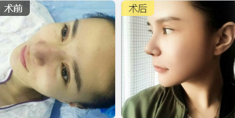 重庆超雅隆鼻手术让你成为隆鼻范本005 重庆超雅隆鼻手术让你成为隆鼻范本005
