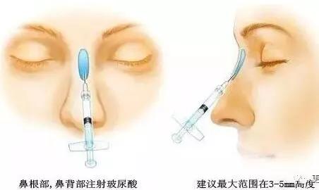 重庆超雅隆鼻手术让你成为隆鼻范本005 重庆超雅隆鼻手术让你成为隆鼻范本005