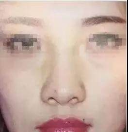 重庆超雅隆鼻手术让你成为隆鼻范本005 重庆超雅隆鼻手术让你成为隆鼻范本005