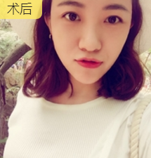 重庆超雅面部提升术让我变回美丽的小姐姐601 重庆超雅面部提升术让我变回美丽的小姐姐601