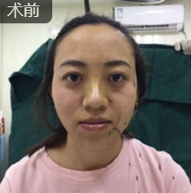 重庆超雅面部提升术让我变回美丽的小姐姐601 重庆超雅面部提升术让我变回美丽的小姐姐601