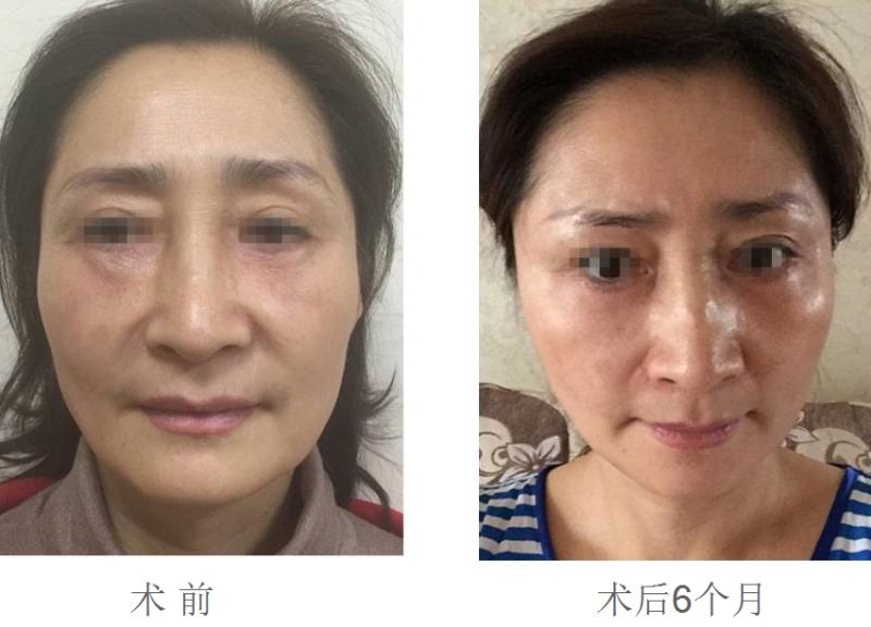 重庆超雅面部提升术让你青春永驻279 重庆超雅面部提升术让你青春永驻279