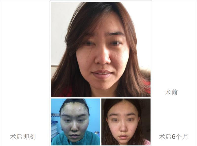 重庆超雅面部提升术让你青春永驻279 重庆超雅面部提升术让你青春永驻279
