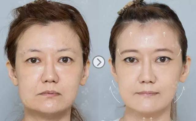 重庆超雅面部提升术让你青春永驻279 重庆超雅面部提升术让你青春永驻279