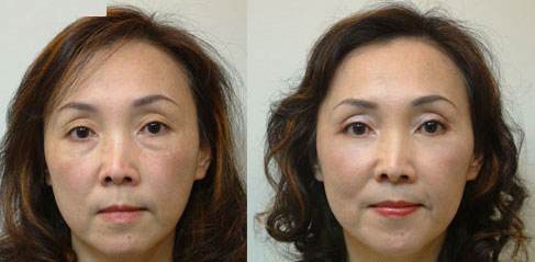 对于眼袋，还是重庆超雅的去眼袋手术清洁的彻底912