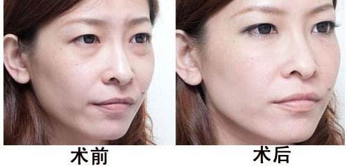 对于眼袋，还是重庆超雅的去眼袋手术清洁的彻底912