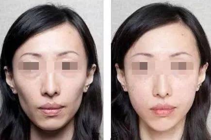 重庆超雅面部提升术,提升面部线条让你永葆青春 重庆超雅面部提升术,提升面部线条让你永葆青春