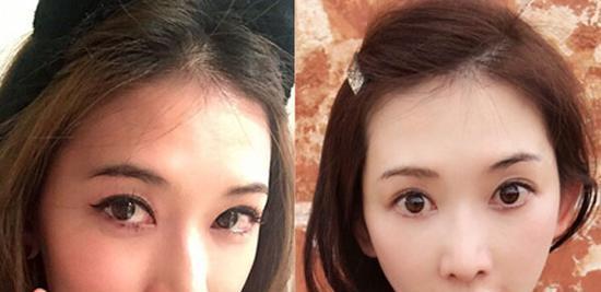 想和志玲姐姐ー样年轻，超 声 波去眼袋手术le解ー下