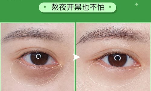 想和志玲姐姐ー样年轻，超 声 波去眼袋手术le解ー下