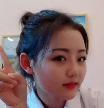 一双自然的双眼皮,超声波双眼皮。389 一双自然的双眼皮,超声波双眼皮。389