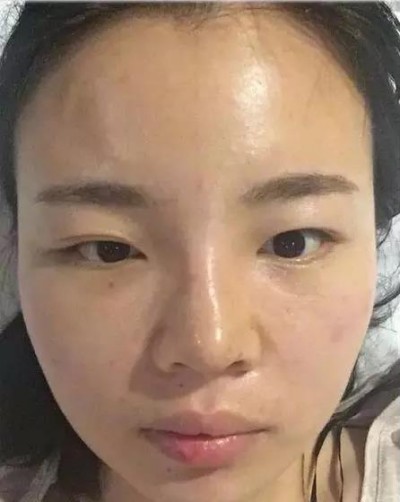 超声波双眼皮,看看我的术后效果分享吧!425 超声波双眼皮,看看我的术后效果分享吧!425