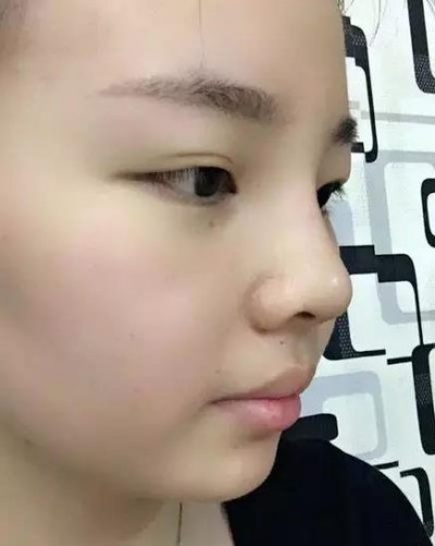 超声波双眼皮,看看我的术后效果分享吧!425 超声波双眼皮,看看我的术后效果分享吧!425