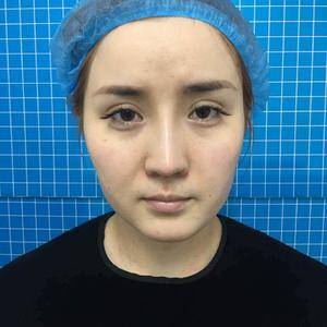 超级微拉美手术塑造童颜紧致肌肤 超级微拉美手术塑造童颜紧致肌肤
