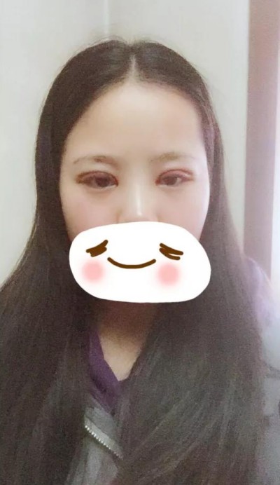 超声波双眼皮,单变双就这么简单169 超声波双眼皮,单变双就这么简单169