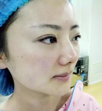 超声波双眼皮让自己变美.413 超声波双眼皮让自己变美.413