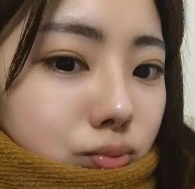超声波双眼皮让自己变美.413 超声波双眼皮让自己变美.413