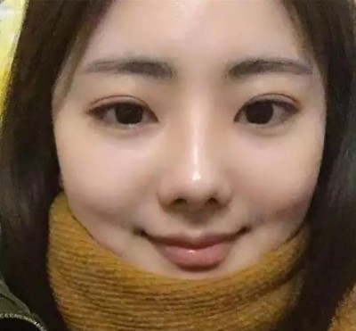 超声波双眼皮让自己变美.413 超声波双眼皮让自己变美.413
