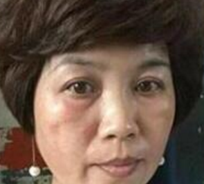 在重庆超雅做了面部提升术,让我找回了青春459 在重庆超雅做了面部提升术,让我找回了青春459