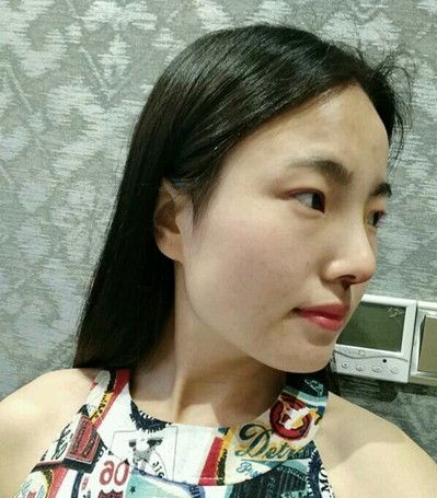 看看我的双眼皮，这双眼皮美美哒有木有，超声波双眼皮914