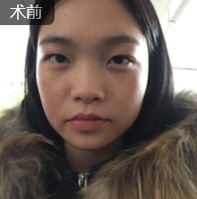 不想做衰老素人就用重庆超雅的面部提升术339 不想做衰老素人就用重庆超雅的面部提升术339
