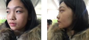 不想做衰老素人就用重庆超雅的面部提升术339 不想做衰老素人就用重庆超雅的面部提升术339