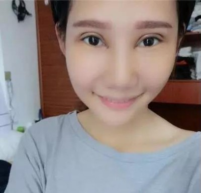 那种自然美,那种天然美超声波双眼皮721 那种自然美,那种天然美超声波双眼皮721