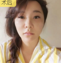 舞蹈老师林梦在重庆超雅面部提升术得效果展示 舞蹈老师林梦在重庆超雅面部提升术得效果展示