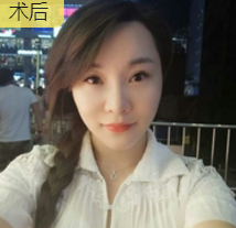 舞蹈老师林梦在重庆超雅面部提升术得效果展示 舞蹈老师林梦在重庆超雅面部提升术得效果展示