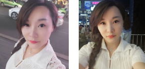 舞蹈老师林梦在重庆超雅面部提升术得效果展示 舞蹈老师林梦在重庆超雅面部提升术得效果展示