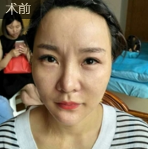 舞蹈老师林梦在重庆超雅面部提升术得效果展示 舞蹈老师林梦在重庆超雅面部提升术得效果展示