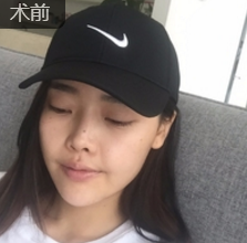 为自己设计一张理想面容——重庆超雅面部提升术778