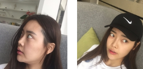 为自己设计一张理想面容——重庆超雅面部提升术778