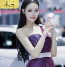 为自己设计一张理想面容——重庆超雅面部提升术778
