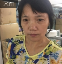 重庆超雅面部提升术让我明白年轻是女人的尊严550 重庆超雅面部提升术让我明白年轻是女人的尊严550