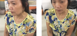 重庆超雅面部提升术让我明白年轻是女人的尊严550 重庆超雅面部提升术让我明白年轻是女人的尊严550