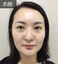 公司文职在重庆超雅面部提升术得效果分享 公司文职在重庆超雅面部提升术得效果分享