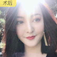 公司文职在重庆超雅面部提升术得效果分享 公司文职在重庆超雅面部提升术得效果分享