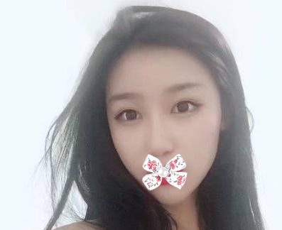 超声波双眼皮一抹我心中之阴霾209 超声波双眼皮一抹我心中之阴霾209
