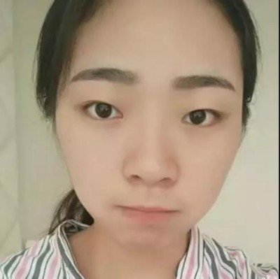 超声波双眼皮,真的越来越漂亮了!656 超声波双眼皮,真的越来越漂亮了!656