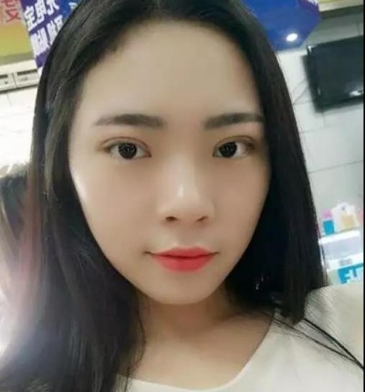 超声波双眼皮,真的越来越漂亮了!656 超声波双眼皮,真的越来越漂亮了!656